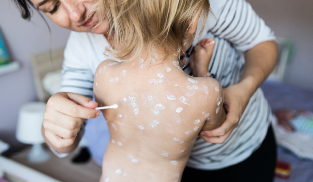 Val de cazuri de varicelă la adulți. Medicii avertizează asupra formelor severe și a riscului de Zona Zoster