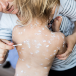 Val de cazuri de varicelă la adulți. Medicii avertizează asupra formelor severe și a riscului de Zona Zoster