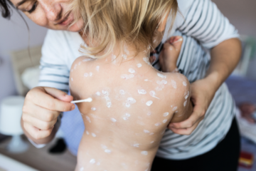 Val de cazuri de varicelă la adulți. Medicii avertizează asupra formelor severe și a riscului de Zona Zoster
