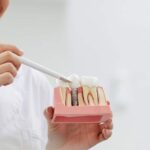 5 Mituri despre implantul dentar pe care ar trebui să le uiți