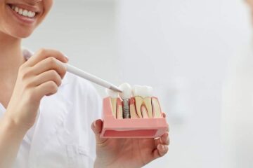 5 Mituri despre implantul dentar pe care ar trebui să le uiți