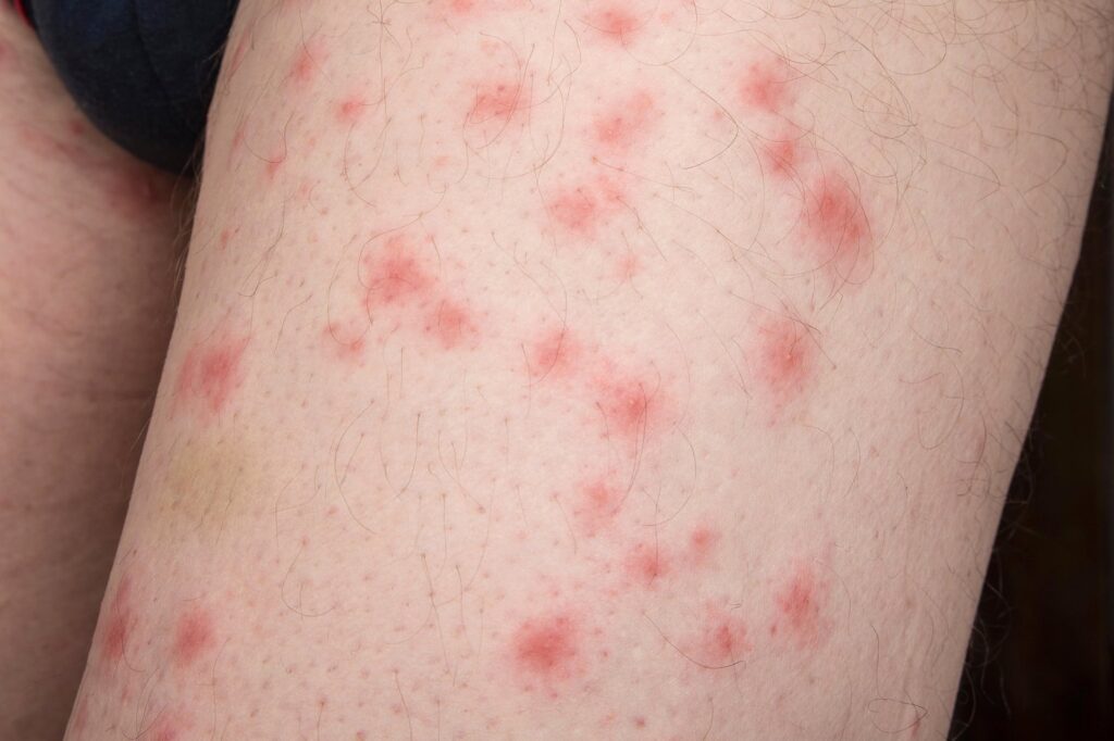 Caz extrem de infestare cu ploșnițe. „Cel mai grav din cariera mea”, spune un specialist cu 38 de ani de experiență